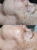 ONLINE KURS i Medicinsk microneedling med BDR Skinstyler apparat + produkt Kit