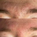 ONLINE KURS i Medicinsk microneedling med BDR Skinstyler apparat + produkt Kit