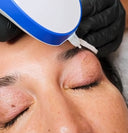 Plasma pen behandling